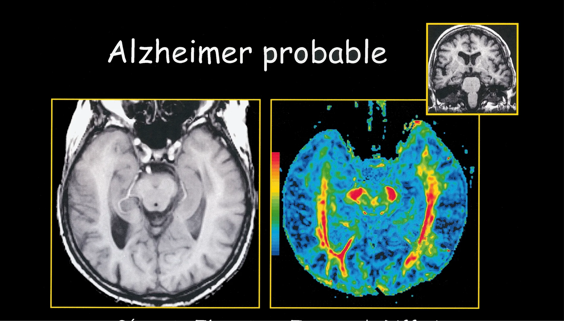 Nearly Half of Dementia Cases May Be Linked to Health Risks You Can Control