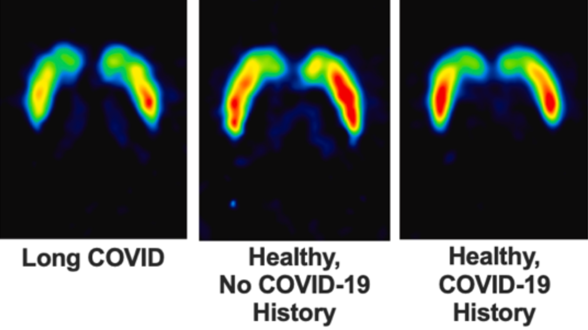 Long COVID Linked to Lasting Damage in The Brain's Dopamine System