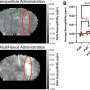 Deadly brain tumors show vulnerability to new sound wave approach