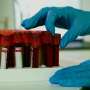 Blood test could speed lymphoma diagnosis in resource-limited settings