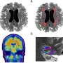 Different inflammatory processes tied to the same Alzheimer's disease-related brain shrinkage and memory loss