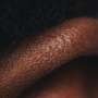 Melanoma treatment mystery gets new answers from mathematical model