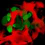 Small spaces and stiffness may help cancer cells escape and spread