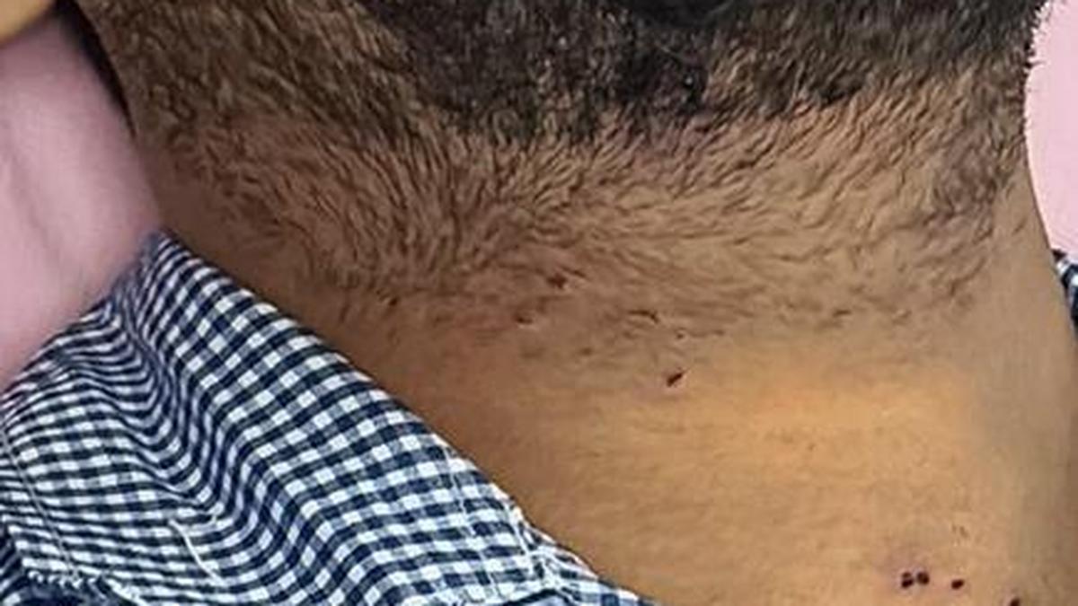 At least 10 people injured by pellets on July 20, shows RTI response