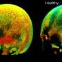 Skull bone marrow inflammation marker rises with chronic pain severity