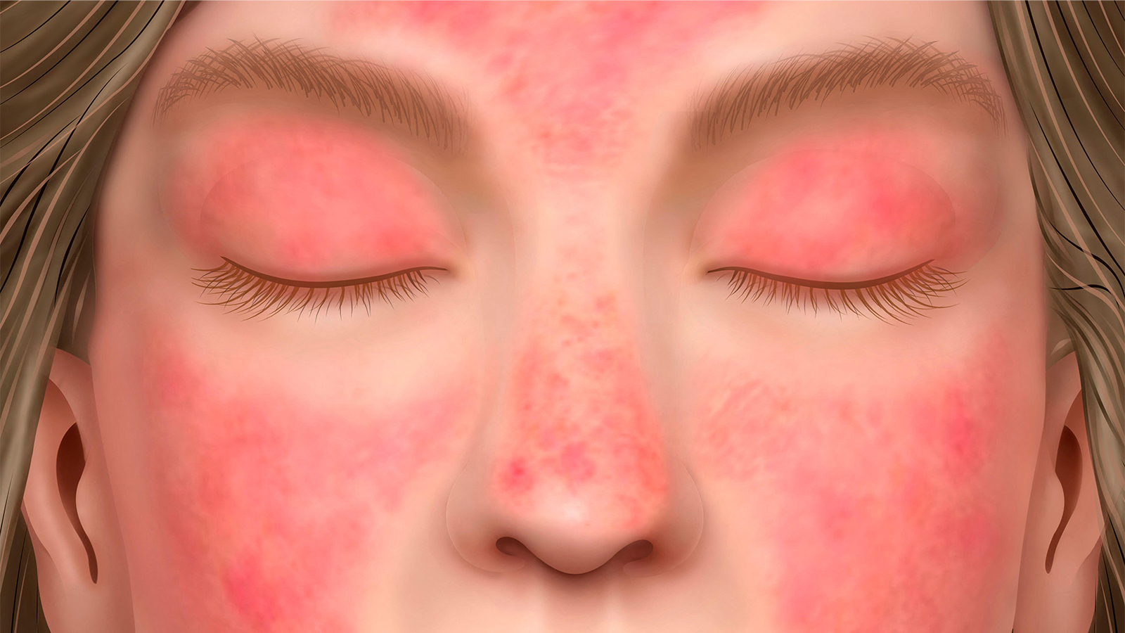 Dramatic Improvement in Dermatomyositis Skin Symptoms With First Approved Oral Agent