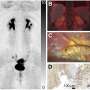 Novel PET/MRI approach improves detection of endometriosis in difficult-to-assess areas