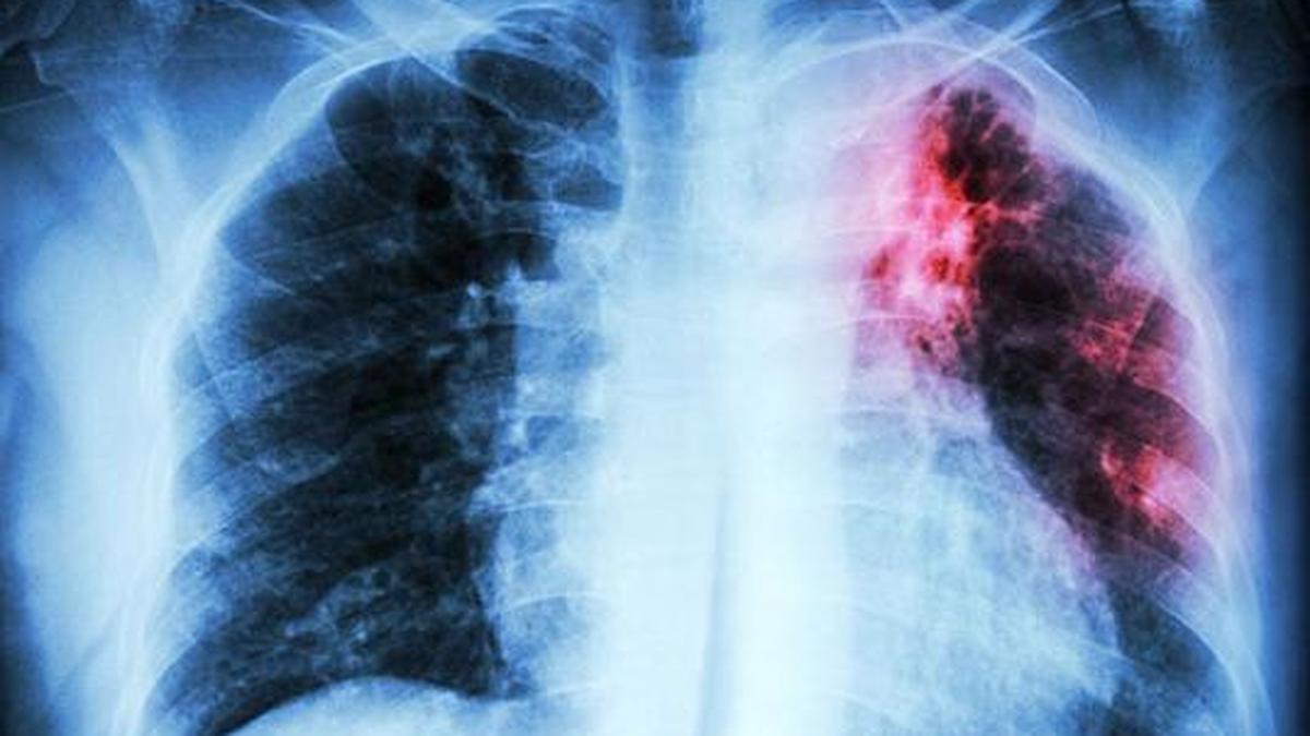 Can integrated multi-testing strengthen TB care and help detect more in one visit?