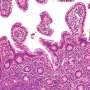 Tumor biology could guide mantle cell lymphoma treatment from the time of diagnosis