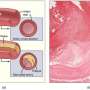 Cancer drug tames atherosclerosis inflammation and plaque in animal models