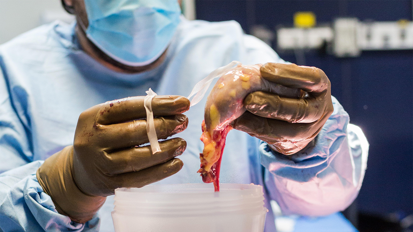 Transplant Care Can't Evolve Without Research-Informed Policy