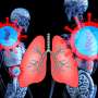 Sarcoidosis shifts lung immune-cell communication, single-cell data suggest