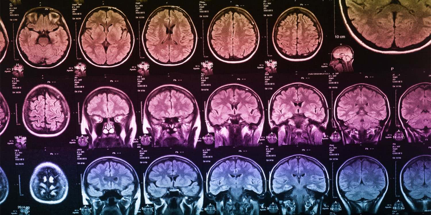 Treatment-resistant depression linked to reduced brain entropy