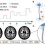 New math model sheds light on multiple sclerosis relapse and recovery cycles