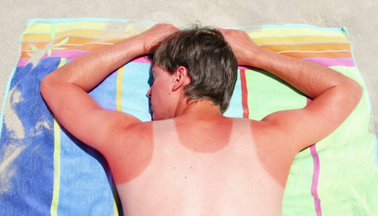 How 1 sunburn can be ‘life-changing’