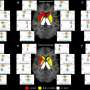 MRI model reveals microstructural brain changes linked to Huntington's disease