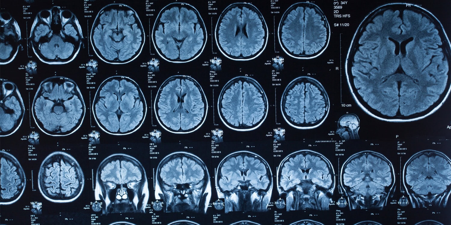 Brain imaging study links childhood trauma to chronic procrastination in adulthood