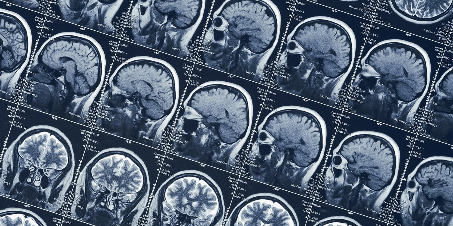 More time spent playing video games is linked to a thinner cerebral cortex in adolescents