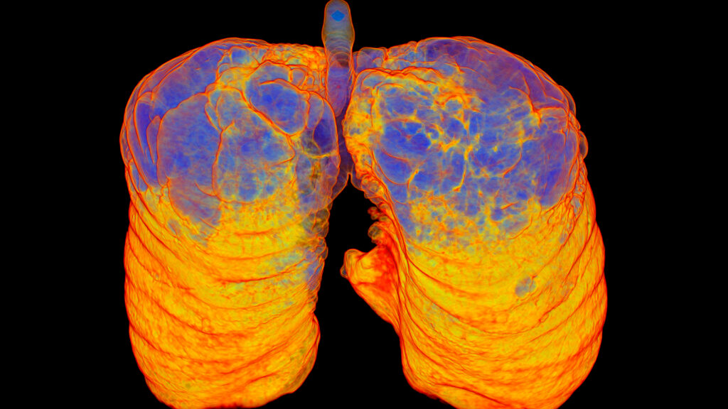STAT+: AstraZeneca’s experimental COPD treatment posts strong results in late-stage studies