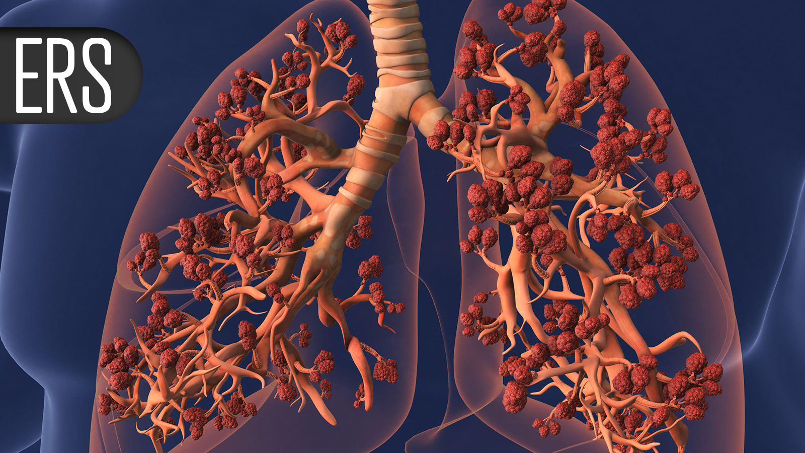 Beta-Blockers Hit With Another Negative Trial in COPD