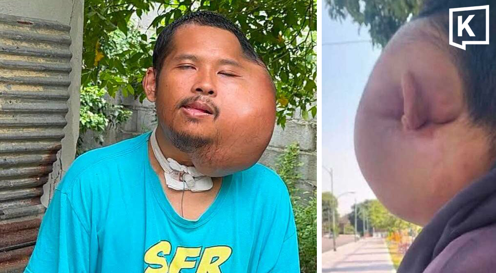 Man with severe facial swelling seeks help amid AI claims
