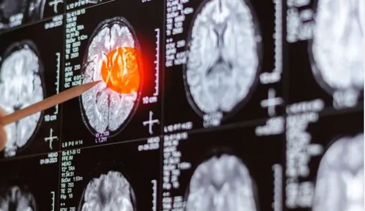 Researchers identify brain cancer weakness that could prevent relapse