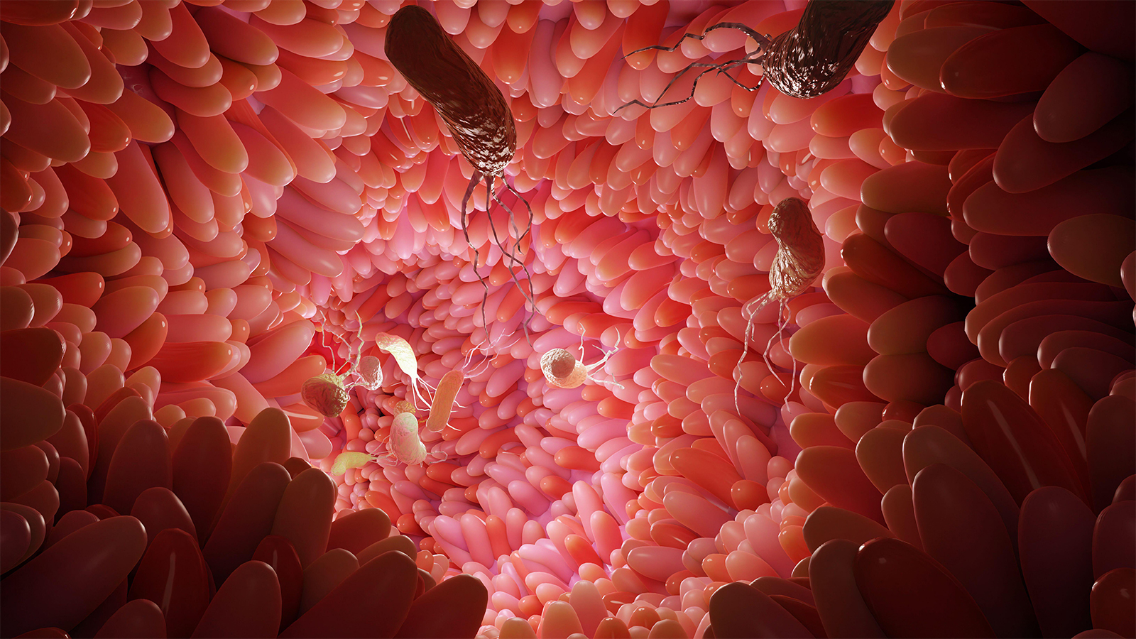 H. Pylori Exposure and Colorectal Cancer: The Evidence Grows