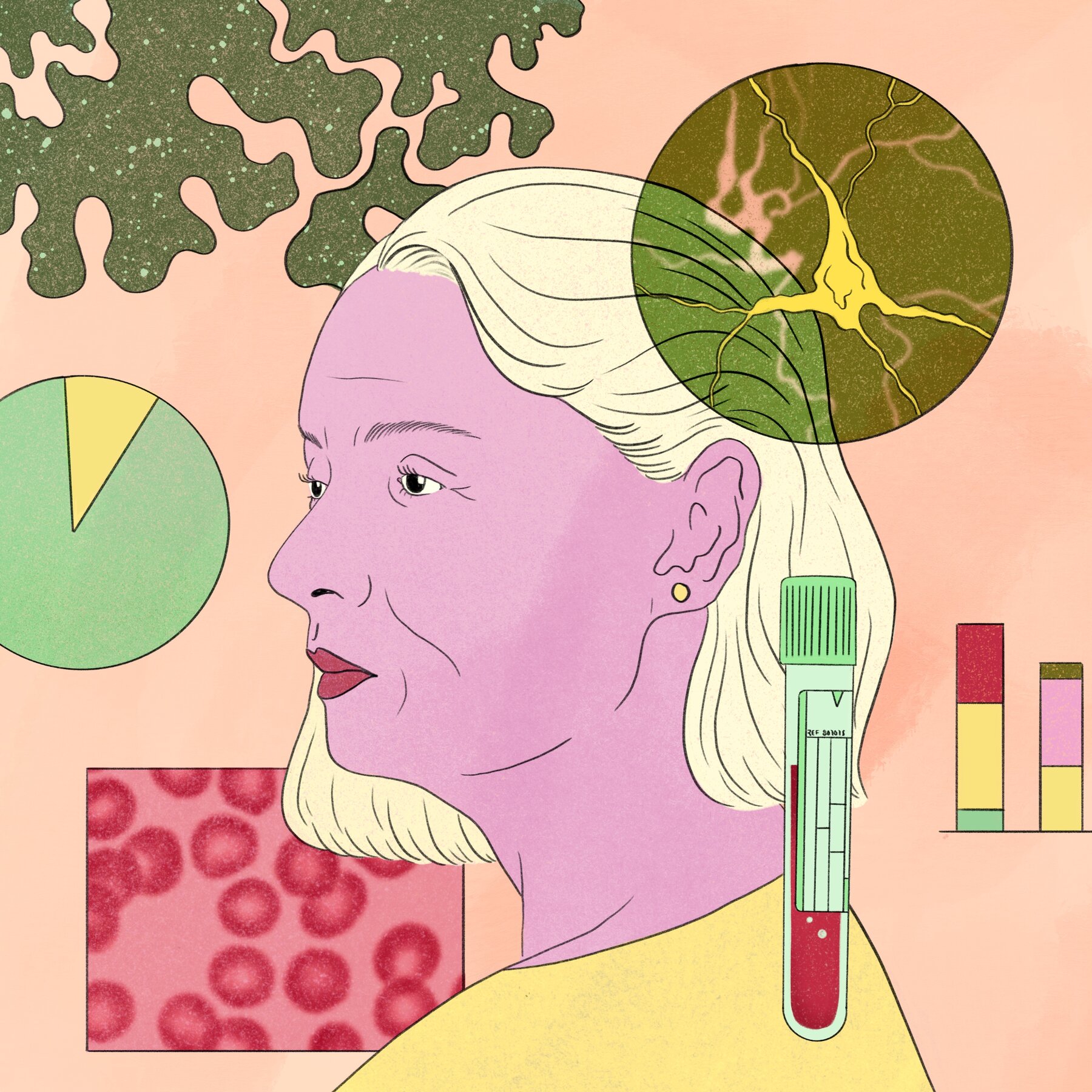 Blood Tests to Predict Alzheimer’s Are Causing Confusion and Distress