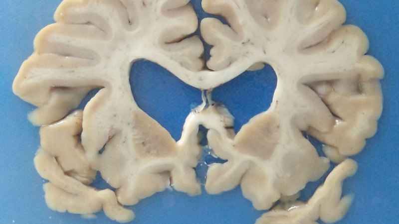 The data on contact sport, concussion and CTE is convincing. But not conclusive