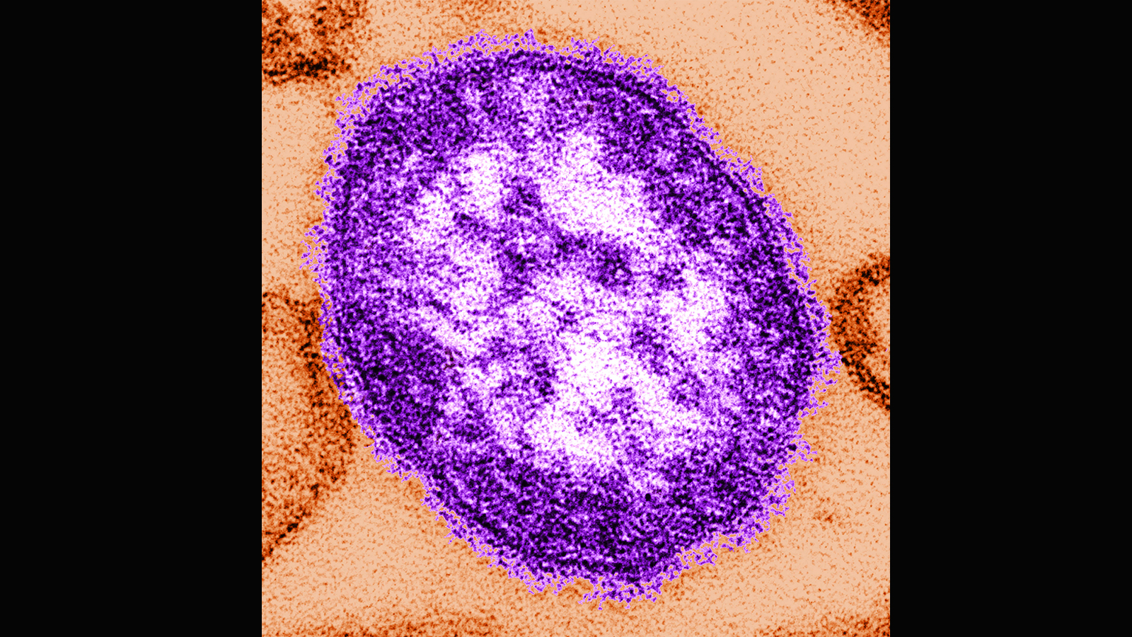 Coroner Releases Details of Infants Who Died Amid Pennsylvania Measles Outbreak