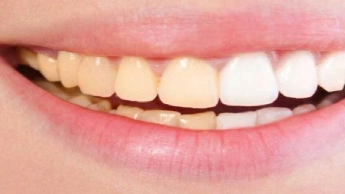 Causes of tooth discoloration and safe ways to restore whiteness