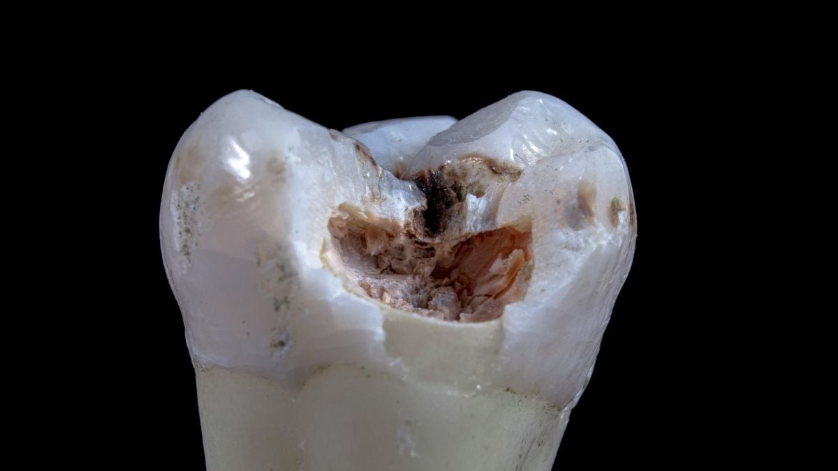 A 10-Second Treatment Can Stop Tooth Decay in Kids Without Drilling