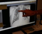We know how to prevent black lung, so why are workers still dying?