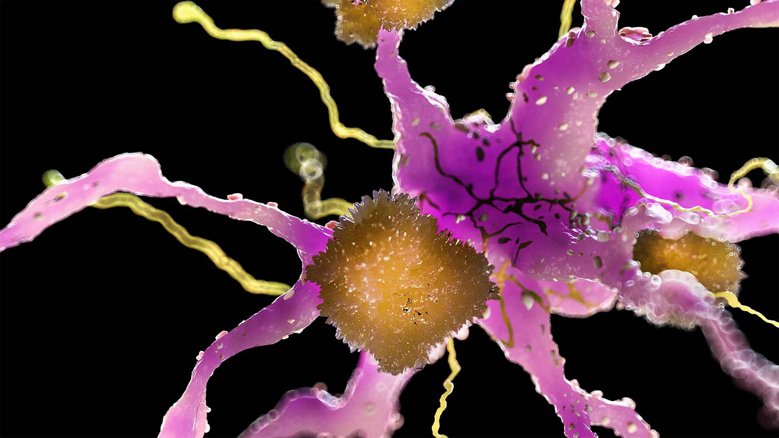 Alzheimer's Risk Lower for Women on Estrogen-Only Menopausal Hormone Therapy