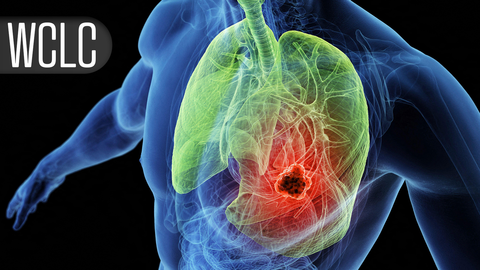 Local Consolidative Therapy After Dual Immunotherapy Fizzles in Metastatic NSCLC