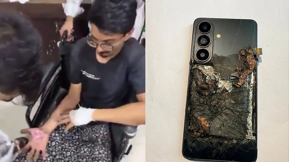 Shocking! Samsung Phone Explodes In Greater Noida Man’s Pocket, Suffers Severe Burns To Both Hands & Lower Body - VIDEO