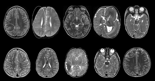 Additional data suggest changes in diagnostics underlie increases in autism diagnoses, and more
