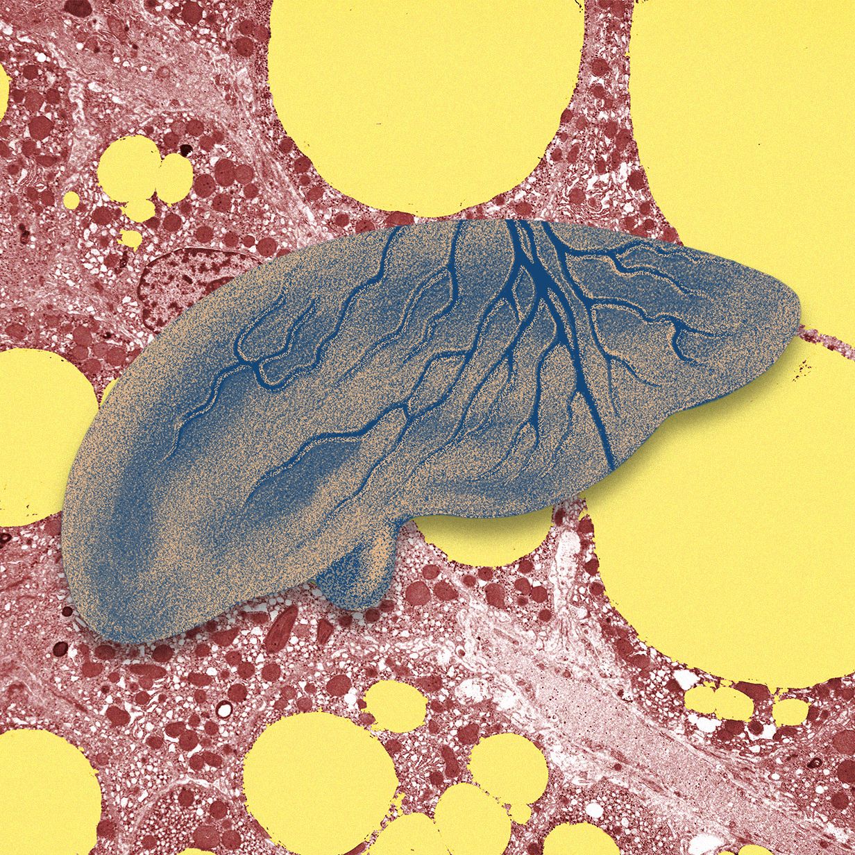 There’s a Fatty Liver Epidemic. AI Could Help Get Ahead of It