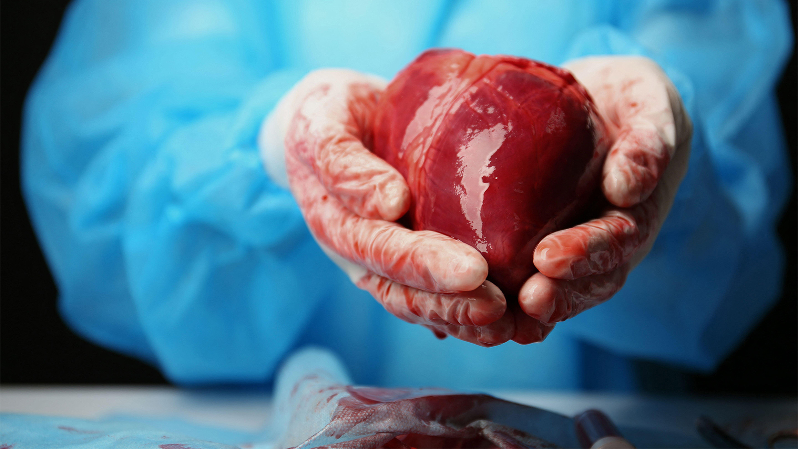Hot-Button DCD Heart Transplants Bolstered by Survival Data