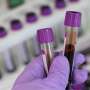 Researchers develop mathematical measures to better personalize therapy for prostate cancer
