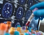 Researchers warn social media driving harmful misuse of Alzheimer’s blood tests