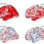 Why brain imaging struggles to identify psychiatric disorder signatures