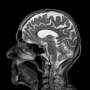 Could the risk of schizophrenia be identified years before the first symptoms appear?