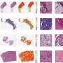 Novel AI model accurately detects key gene mutations and predicts biomarkers across 32 cancer types