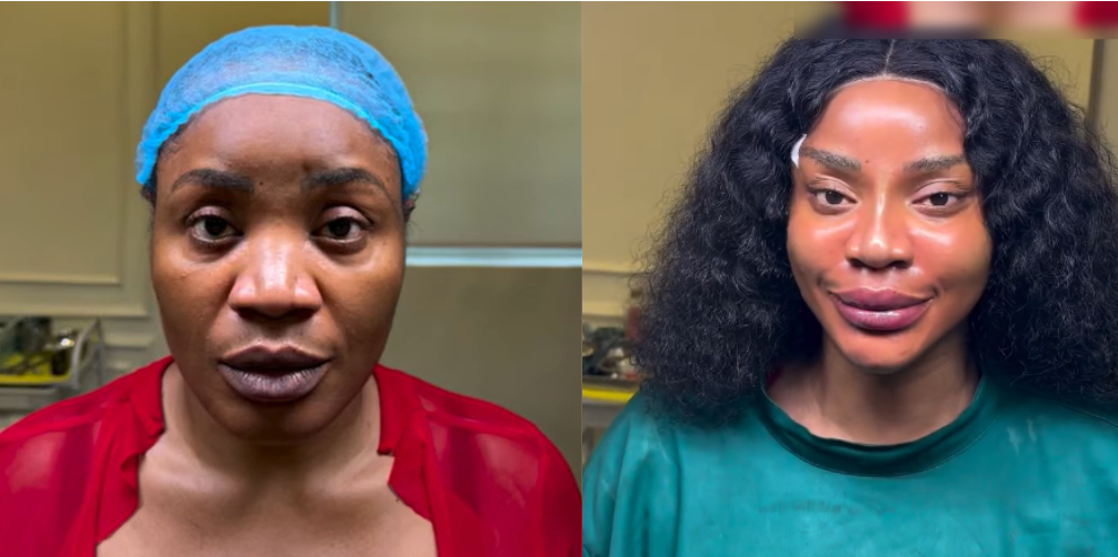 Actress Uche Ogbodo undergoes facial rejuvenation after liposuction [Video]