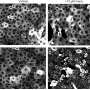 Darier disease cells lose antioxidant defenses under stress, study finds