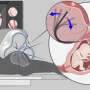 Robotic help in high-risk twin pregnancies: Panoramic guidance for a flexible laser scope
