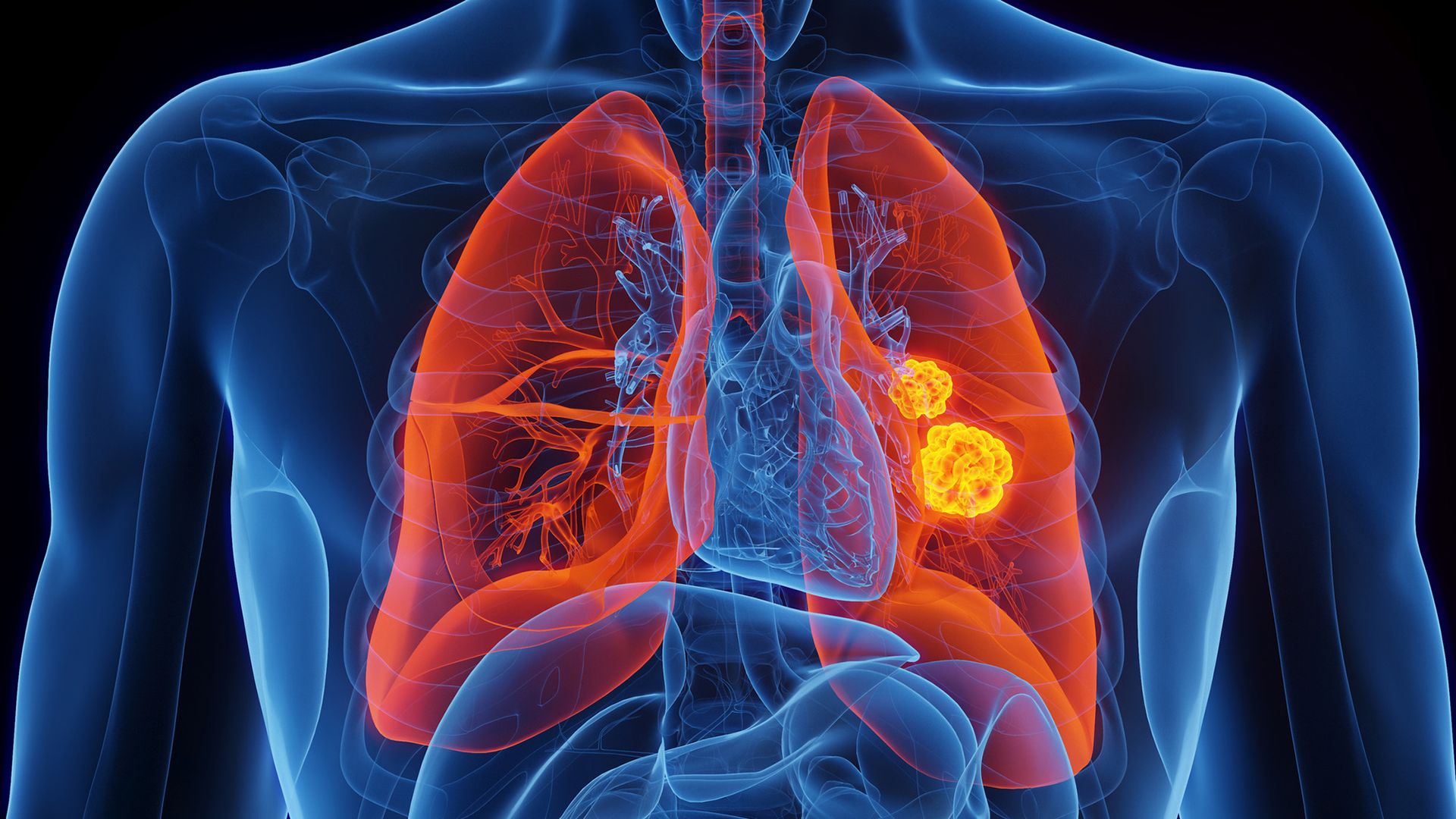 Scientists identify rare genetic mutation that dramatically raises risk of lung cancer in nonsmokers