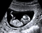 We terminated a pregnancy so our daughter never had to suffer. It was agony. It cannot be the right of One Nation – or any anti-abortion activist – to choose for us | Anonymous