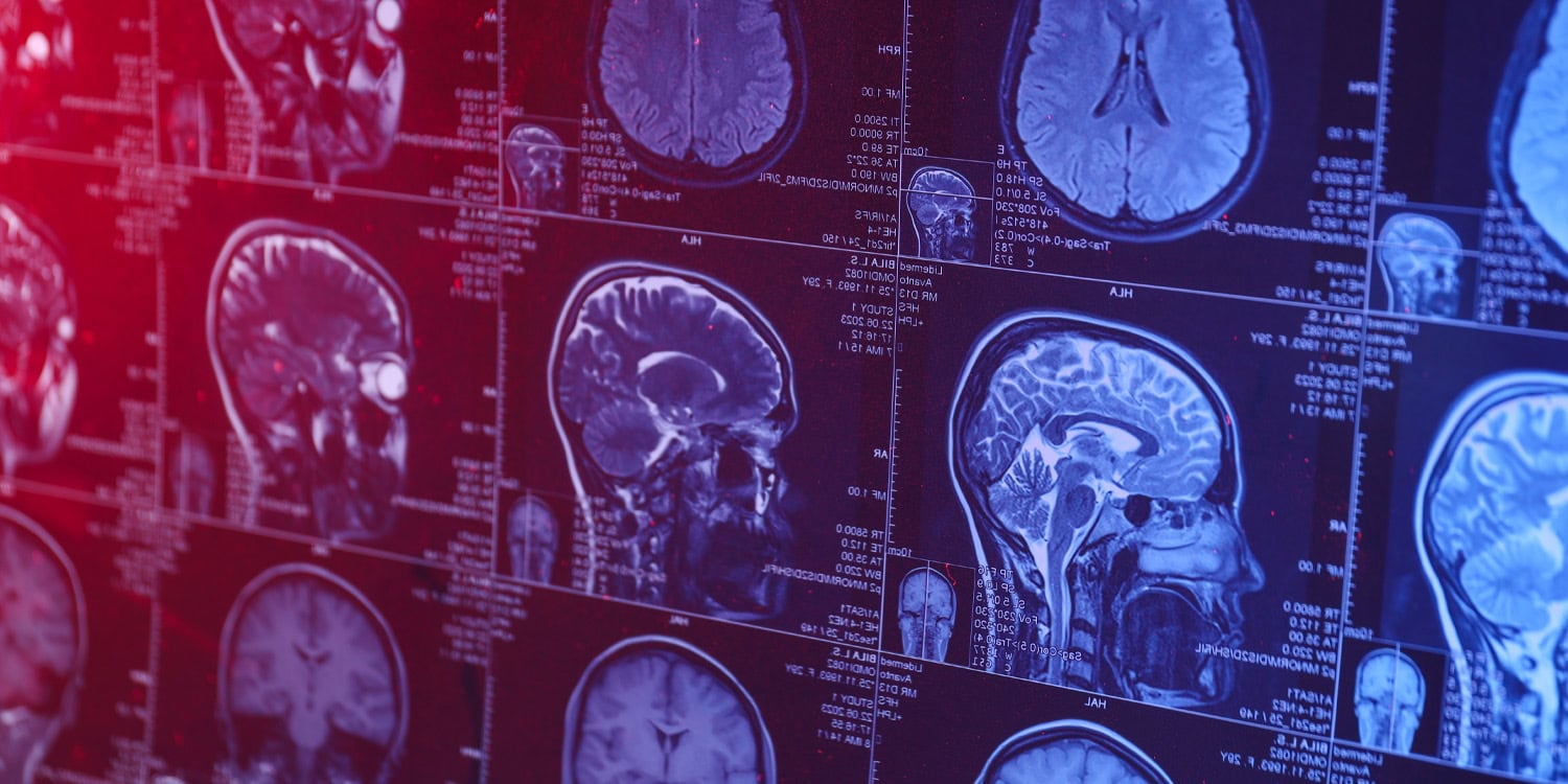 Do antidepressants actually alter brain structure? A massive neuroscience study weighs in